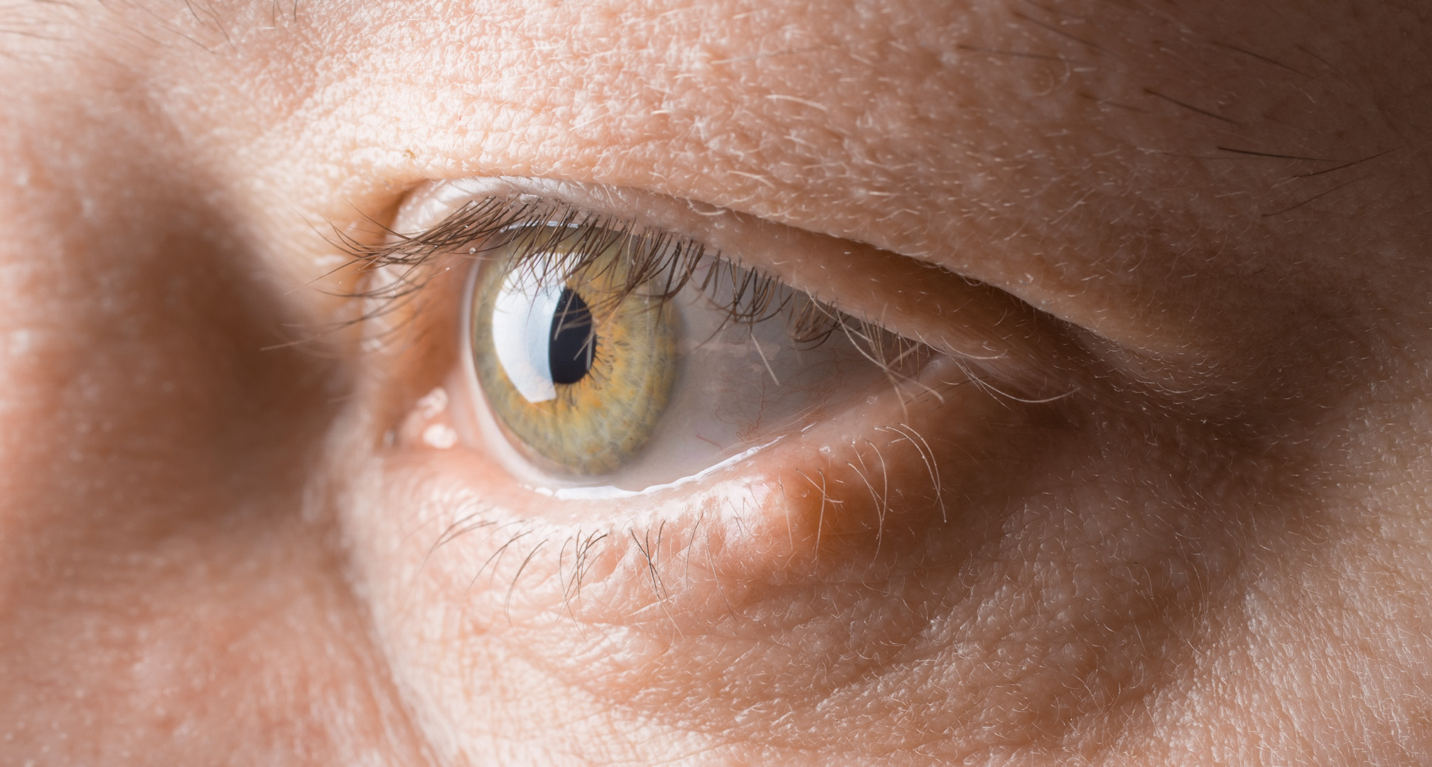 Ракът на клепача може да се прояви като малък възел на клепача . Ракът на клепачите сам по себе си не засяга зрението, което означава, че зрителното ви поле ще остане нормално. Ако обаче не се лекува, ракът може да се разпространи в околните структури, което може да повлияе на зрението.