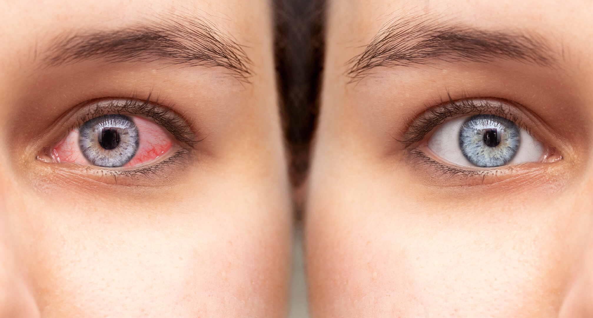близък план на две очи едно до друго, червено сухо око отляво и здраво око отдясно
