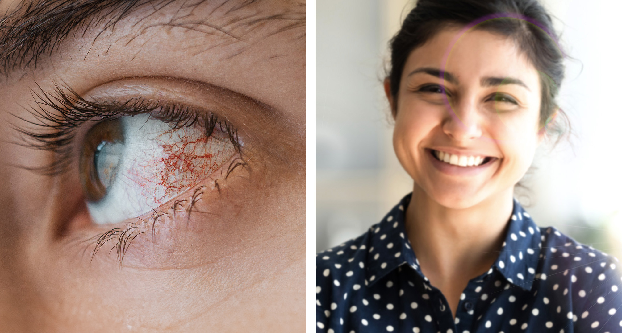 Фотокератитът може да доведе до зачервени или кървясали очи (вляво). Въпреки че не винаги е така, може да доведе до замъглено зрение или симптоми като виждане на ореоли в зрителното поле (вдясно).