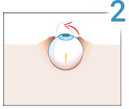 Lasik, step 2