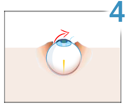 Lasik, step 4